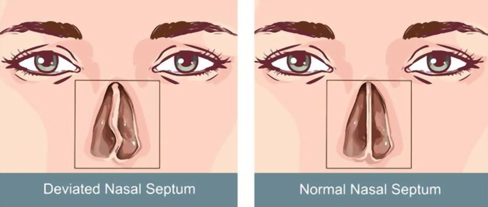 deviated nasal septum