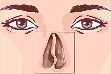deviated nasal septum