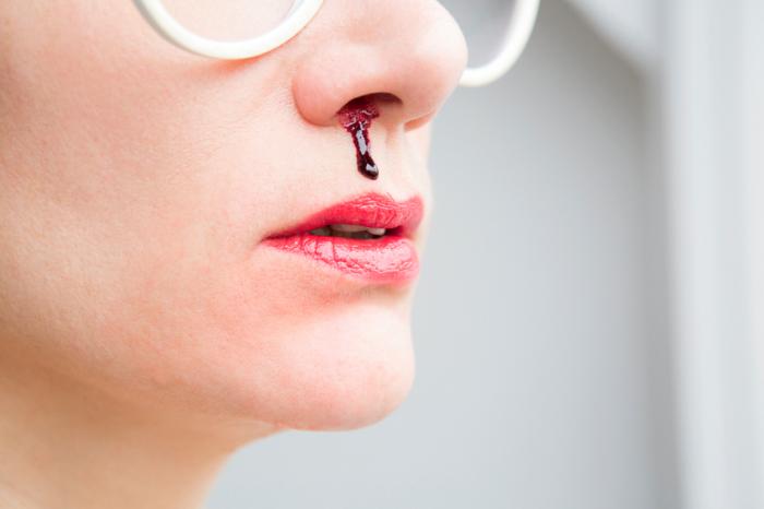 Nasal Bleeding Epistaxis Treatment Nasal Bleeding Epistaxis Treatment