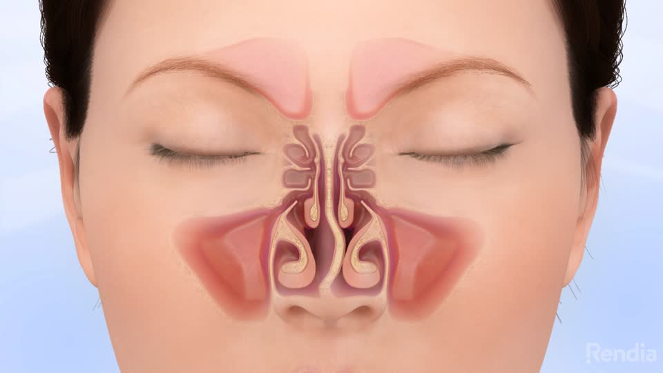 Turbinates Hypertrophy Treatment Turbinates Hypertrophy Treatment